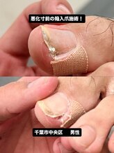 巻き爪じゅん 千葉駅前店/悪化する前に対応した陥入爪