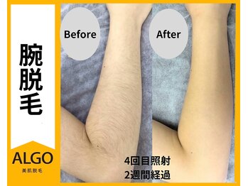 アルゴ 山口宇部店(ALGO)/ショット数4倍で効果抜群！