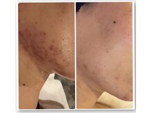 ママナ(mamana)/ニキビコース　モニター募集