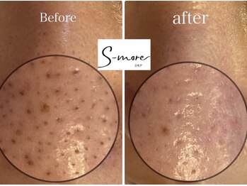 ラトワ(LATOWA)の写真/【１回で毛穴垢抜け★】毛穴診断を元に、カスタムピーリング＆毛穴エクストラクション＆引き締め徹底♪