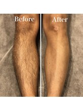 ミーエイト(Mii∞)/《膝下Before/After》