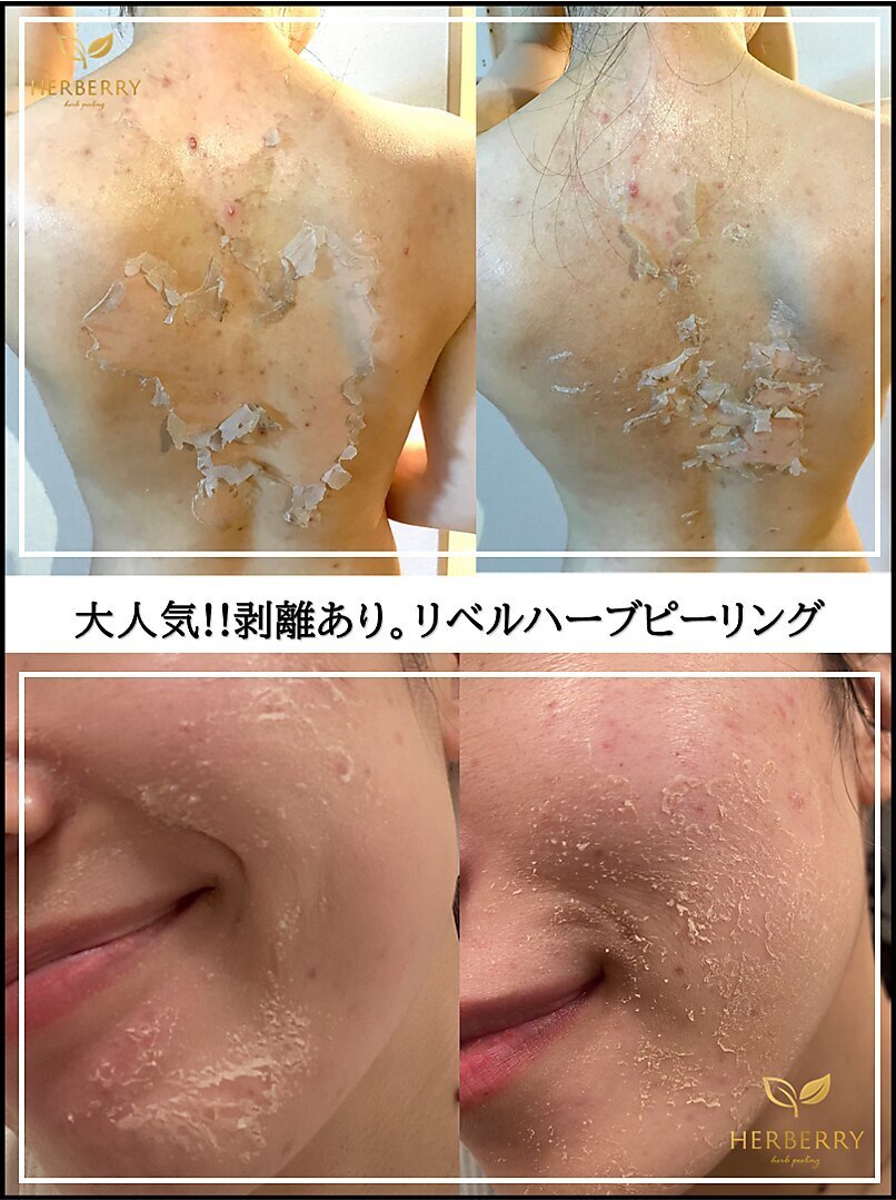 剥離の加減 調整可能♪｜ハーバリー ハーブピーリング 金山店(HERBERRY