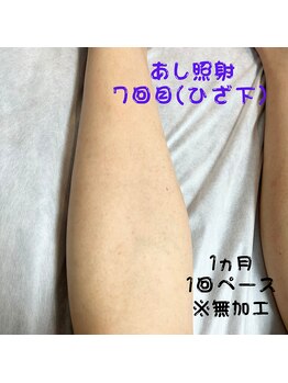 フェリッセ(FELISSE)/あし脱毛 照射7回目【M様】