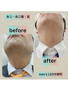 ランドマーク 中崎町(LANDMARK.)/《 あご・あご裏・首 》