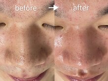 アルカンシエル(arcenciel)/毛穴改善コース