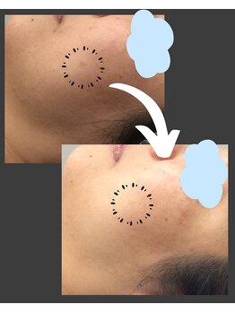 トラレス(Trouless)/プラズマシミケア