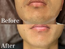 ボス 岡崎店(BOSS)/【メンズ脱毛/ヒゲ脱毛】