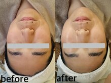 メナードフェイシャルサロン 西五反田/透明感/小顔/赤み鎮静