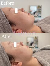 ルノン(Lunon)/毛穴洗浄ハイドロ×ララピール