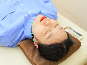 がんばる接骨院の写真/【美容鍼を受けたことがない方大歓迎!】女性鍼灸師による丁寧な施術で理想の小顔に♪