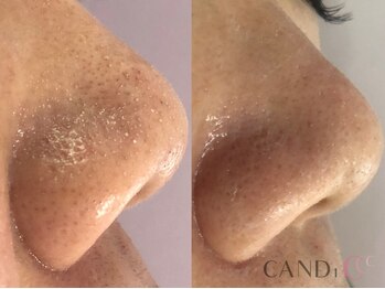 キャンディ 岐阜(CANDi)/ハイドラピーリング/黒ずみ毛穴