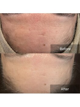 サロンツキ(salon tuki)/【ハーブピーリング】症例