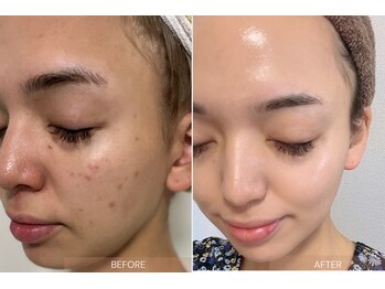 ディアブルー 平塚店(diar blue)/クリスティーナ　ピーリング