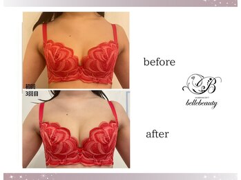 ベルビューティー(belle beauty)/バストアップ◇症例◇