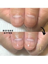 プラスワン(+1)/ハンド深爪矯正