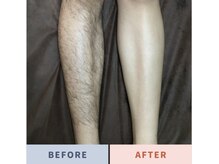 ダンディラボ(Dandy Lab)/脚脱毛ビフォーアフター