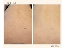 レヴ 都城店(rev)/背中のケアも