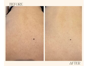 レヴ 都城店(rev)/背中のケアも