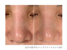 ルーム(room)/ハーブトリートメント2回