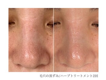 ルーム(room)/ハーブトリートメント2回