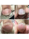 巻爪ケア