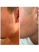 シアンビビ(Cyaan bibi)/men's顔脱毛（もみあげ）