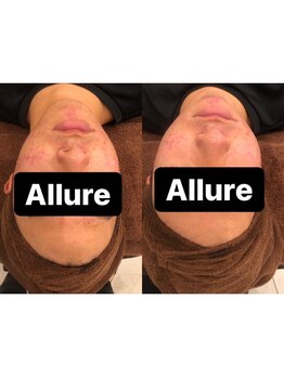 アリュール(Allure)/肌質改善コルギ（３０代男性）