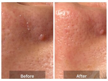 ステッラ(STELLA☆)/毛穴洗浄　Before/After