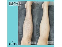 アクト クロ(ACT curro)/【脚全体】脱毛施術例
