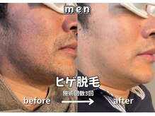 キュー(cue)/【メンズ】「ヒゲ脱毛」3回