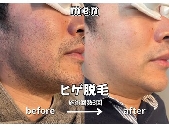 キュー(cue)/【メンズ】「ヒゲ脱毛」3回