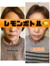 ララピール＋レモンボトル(脂肪分解)3回コース