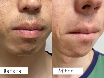 セルフメイド 高崎店(SELFMADE)/ヒゲ脱毛10回目ビフォーアフター