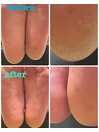 角質ケアbefore after