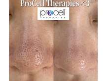 フェイシャルサロン アリイ(ALII)の雰囲気（プロセルで小鼻の開き改善♪）