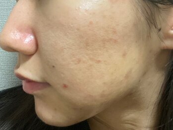 リベル 名古屋(Lebelle:)/ハーブピーリング 名古屋