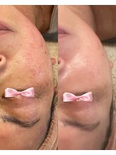 美温(mion)/美温式お任せフェイシャル