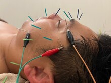 セン(SEN)/メンズも美容鍼！