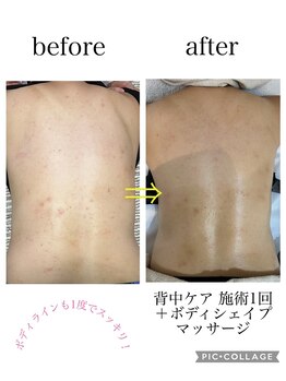 ヨロ 梅郷店(YOLO)/背中ケア (角栓・ニキビケア)