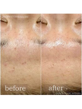 サロン ド ブラン アオヤマ(Salon de BLANC AOYAMA)/ハーブピーリング&ソノケア