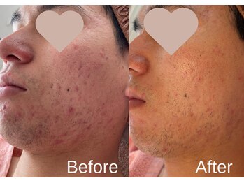 綺麗サロン 脱毛アンドフェイシャル ジュエル(Jewel)/【4BミネラルクリアTR】