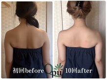 キュープ 福岡天神店(Qpu)/巻き肩コース４回での変化