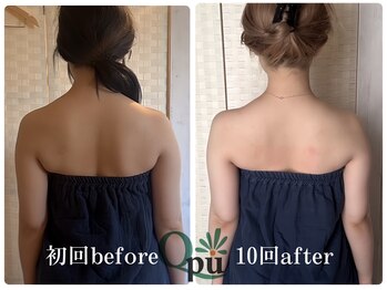 キュープ 福岡天神店(Qpu)/巻き肩コース4回での変化