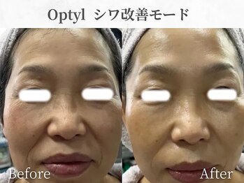 芯美 恵比寿店(shinbi)/オプティル*LDM水玉リフティング