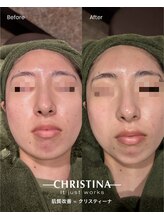 ラセラピー(RaTHERAPY)/お客様の肌の変化
