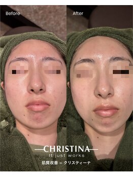 ラセラピー(RaTHERAPY)/お客様の肌の変化