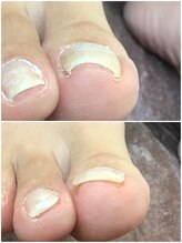 モアクリスタル(More Crystal)/巻き爪補正