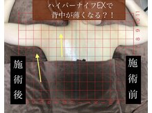 リヘッド(Re.head)/ハイパーナイフEX 二の腕施術