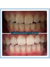 ホワイトニングショップ 堺東店/【ビフォーアフター】10回