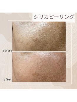 アンジェリカ(Angelica)/シリカピーリング